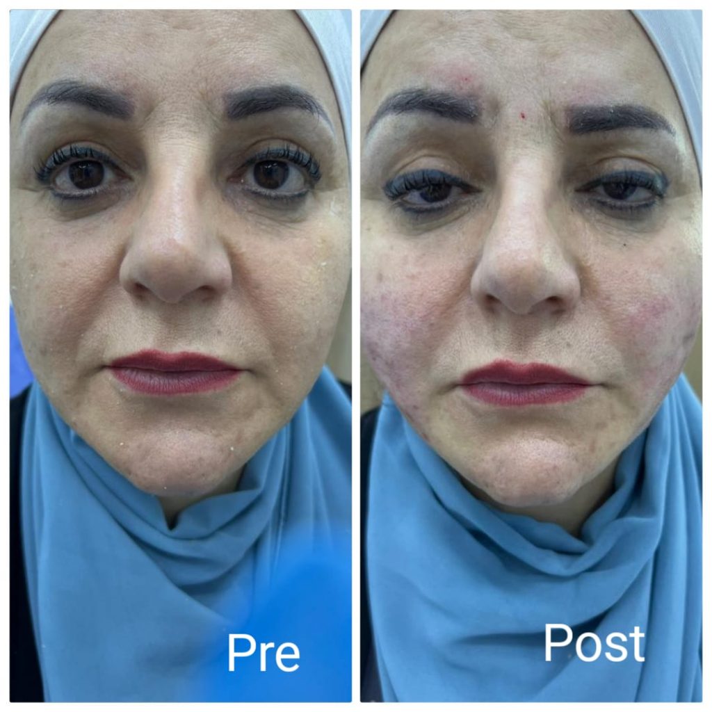 تكبير وشد الخدود